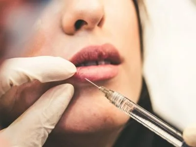 Lip Lift — Medical Linares