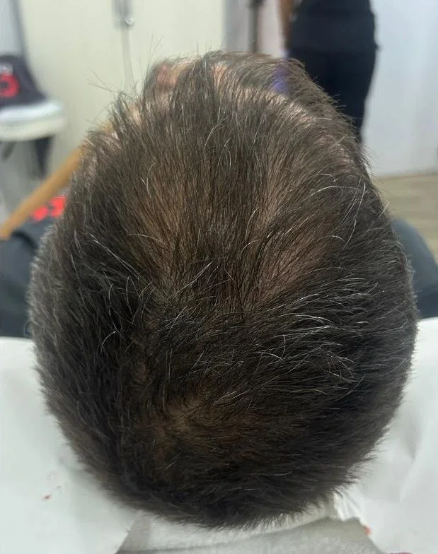 La misma coronilla con la densidad recuperada después del injerto capilar