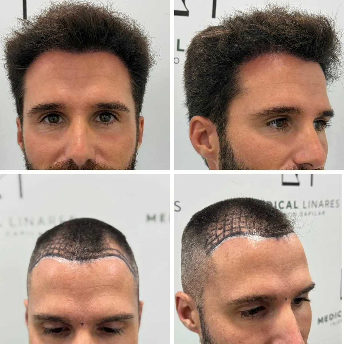 Injerto capilar para recuperar densidad en la zona frontal: cuatro vistas del antes y el después