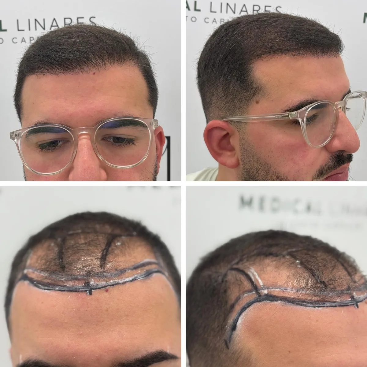 Diseño de la línea frontal marcado sobre el cuero cabelludo y resultado del injerto capilar