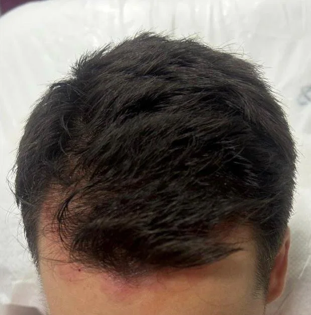 La misma zona frontal ya poblada y con densidad, resultado del injerto capilar
