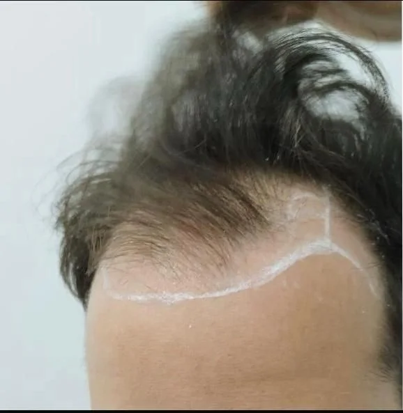 Línea frontal antes del injerto capilar, con el diseño de la nueva línea marcado sobre la piel