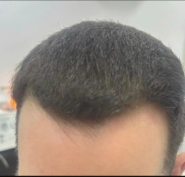 La misma línea frontal después del injerto capilar, ya poblada y con nacimiento natural