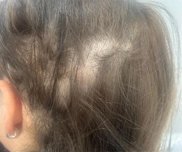 Placa sin pelo por alopecia areata en el cuero cabelludo de una mujer, antes del tratamiento