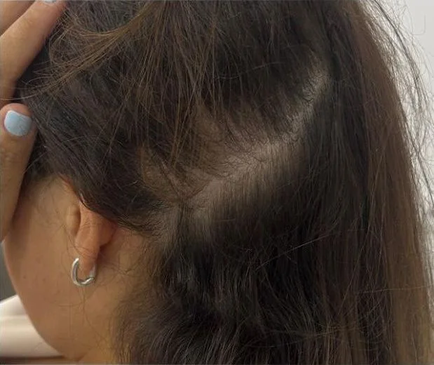 La misma zona repoblada después del tratamiento de la alopecia areata
