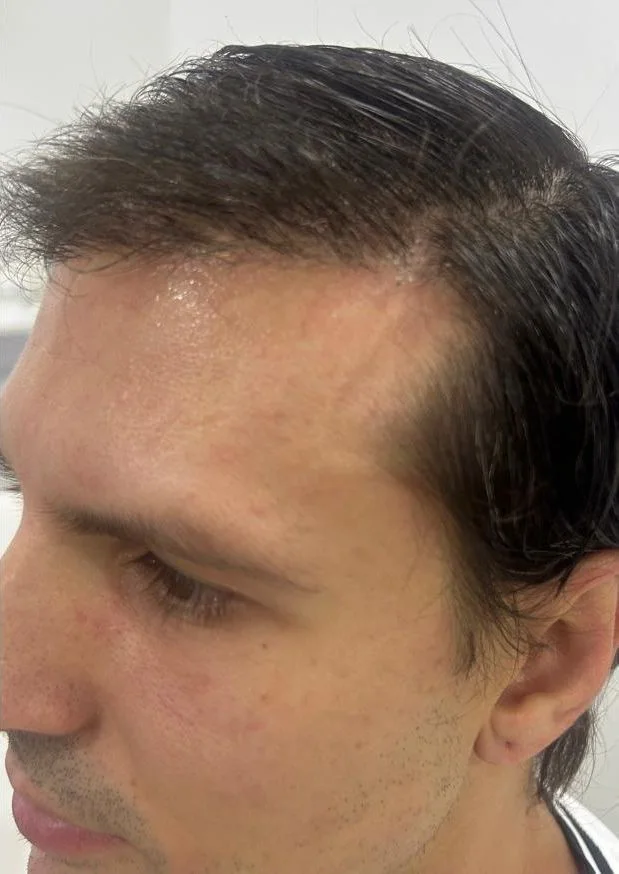 El mismo perfil con la línea de nacimiento recuperada tras el injerto capilar