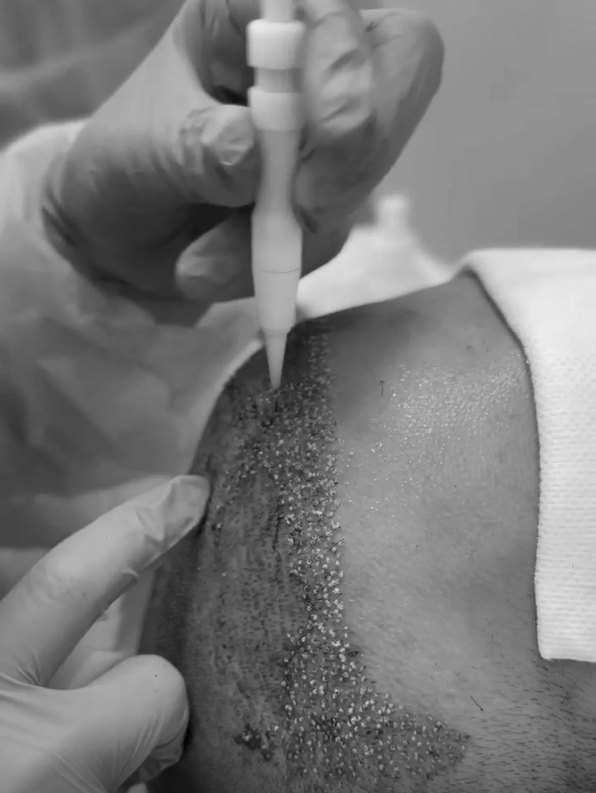 Injerto capilar DHI en Medical Linares
