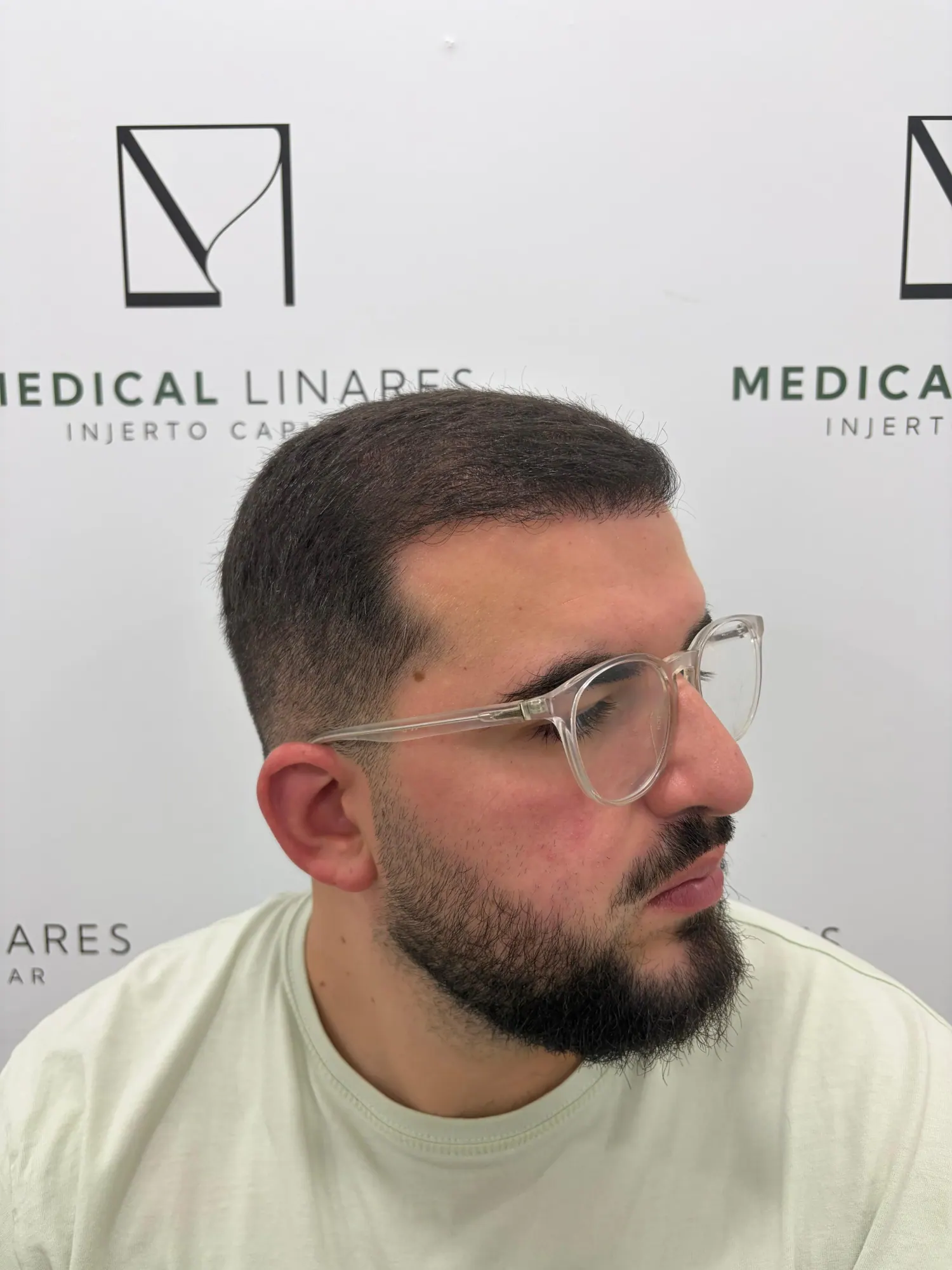 Mesoterapia capilar en Medical Linares