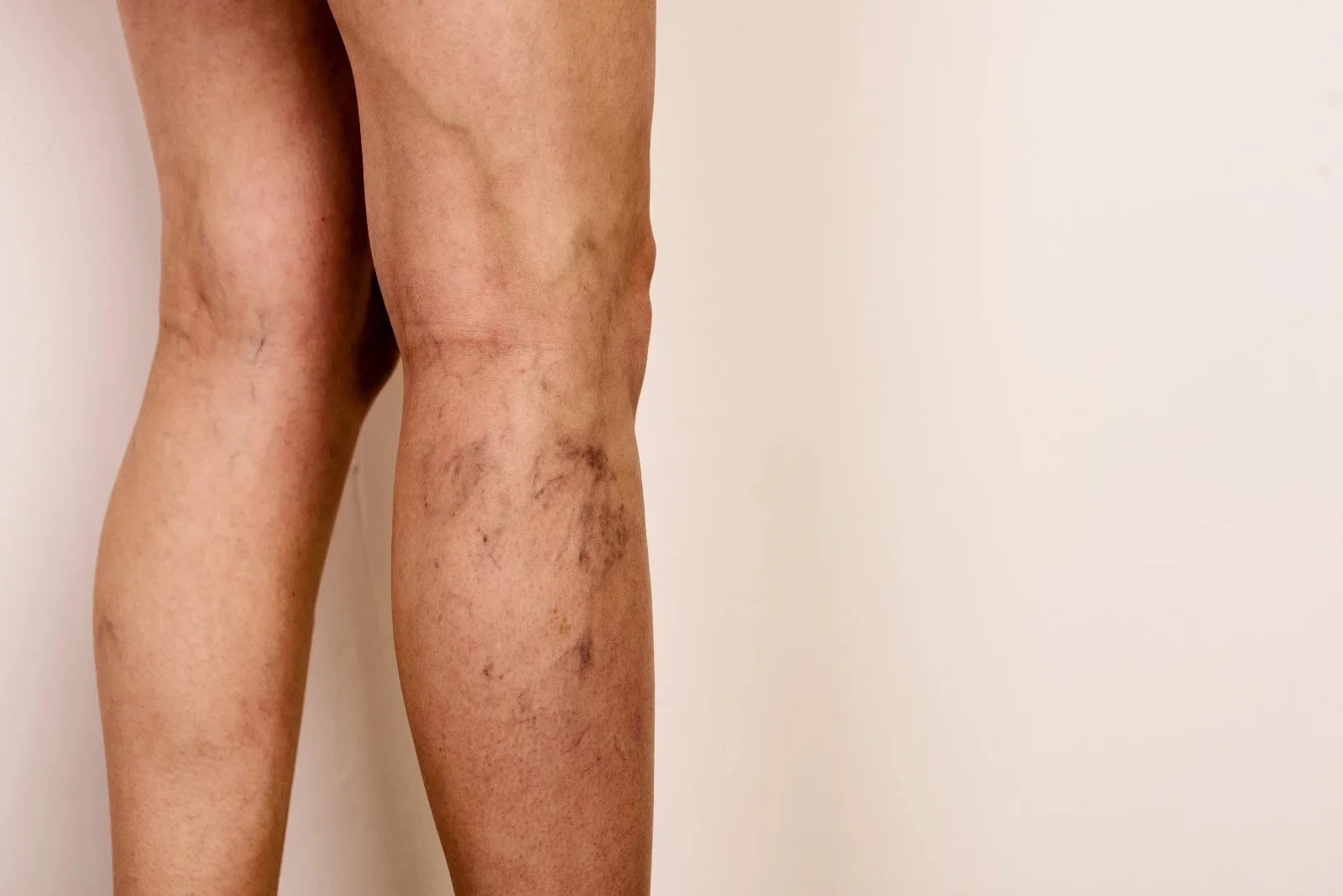 Arañas y lesiones vasculares — Medical Linares