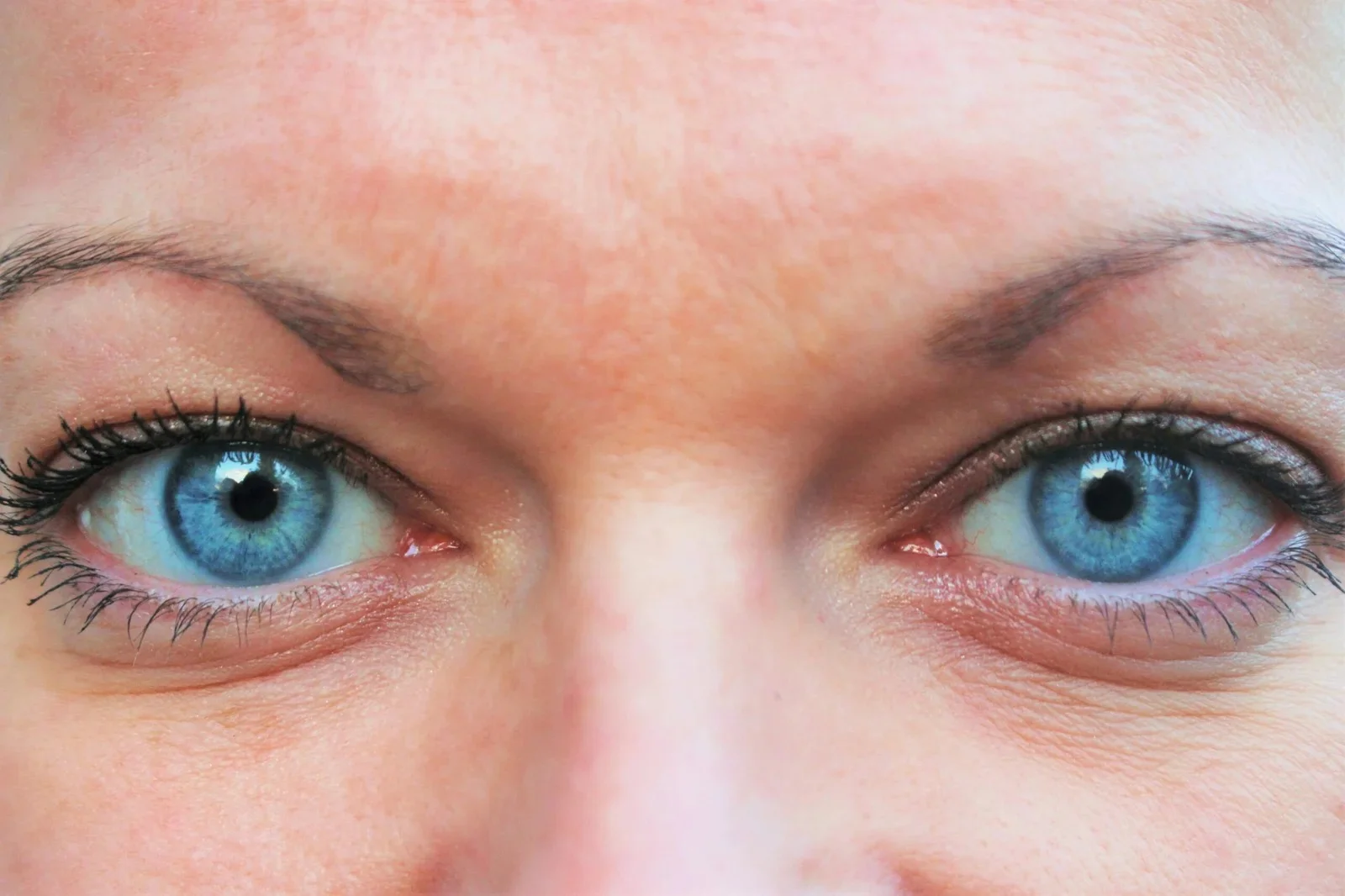Relleno de ojeras — Medical Linares