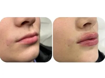 Perfilado y relleno de labios — Medical Linares