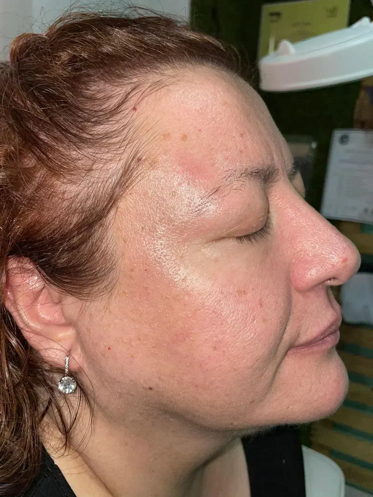 Bioestimulación facial en Medical Linares
