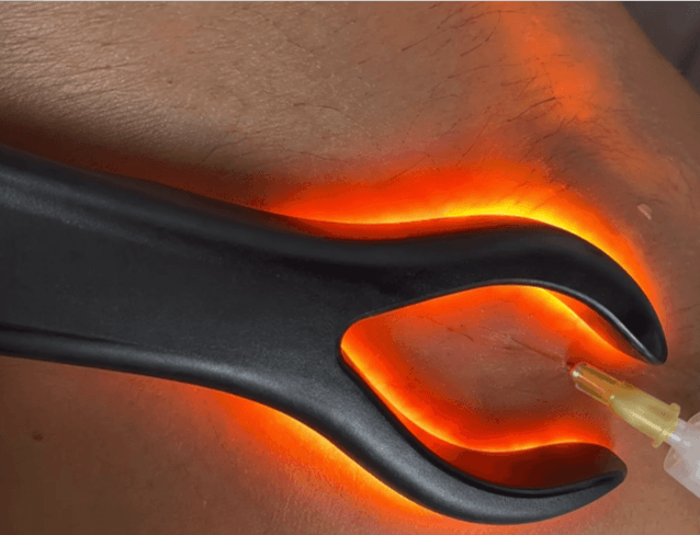 Esclerosis vascular — Medical Linares