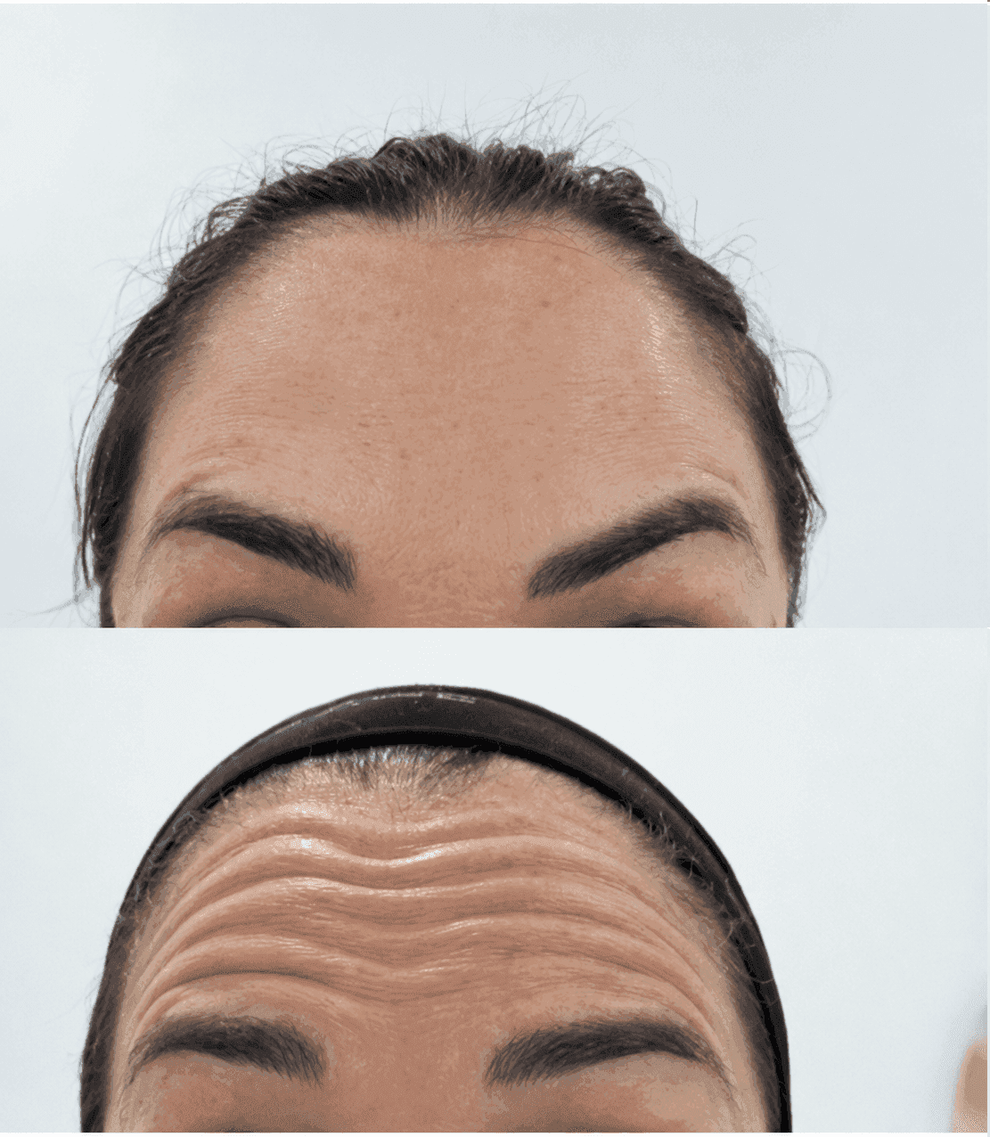 Neuromoduladores en mujeres — Medical Linares