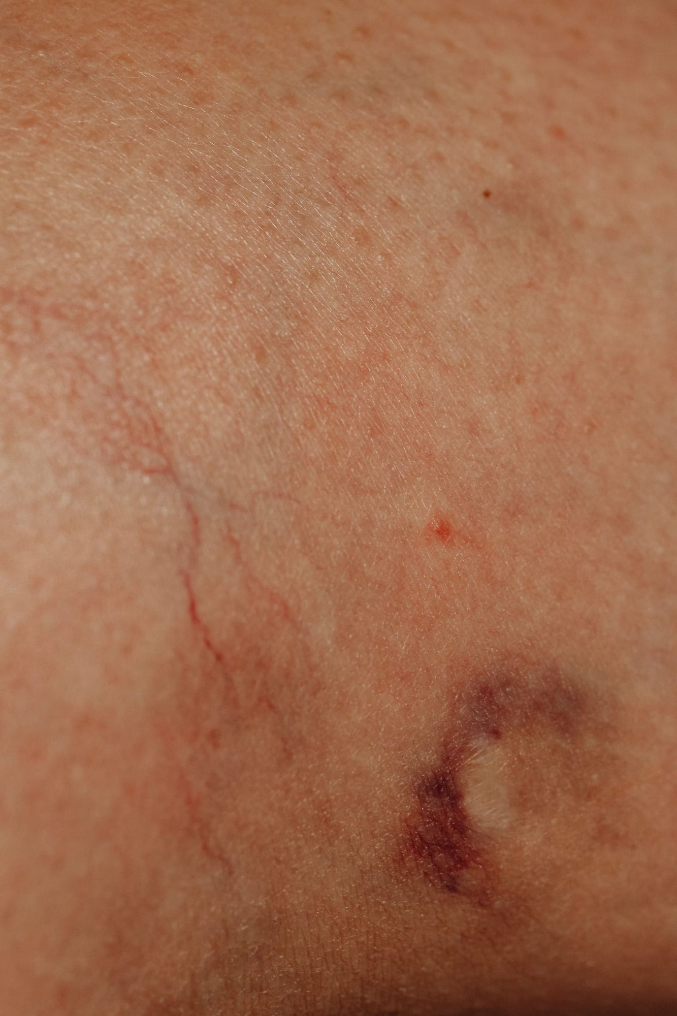 Esclerosis vascular — Medical Linares