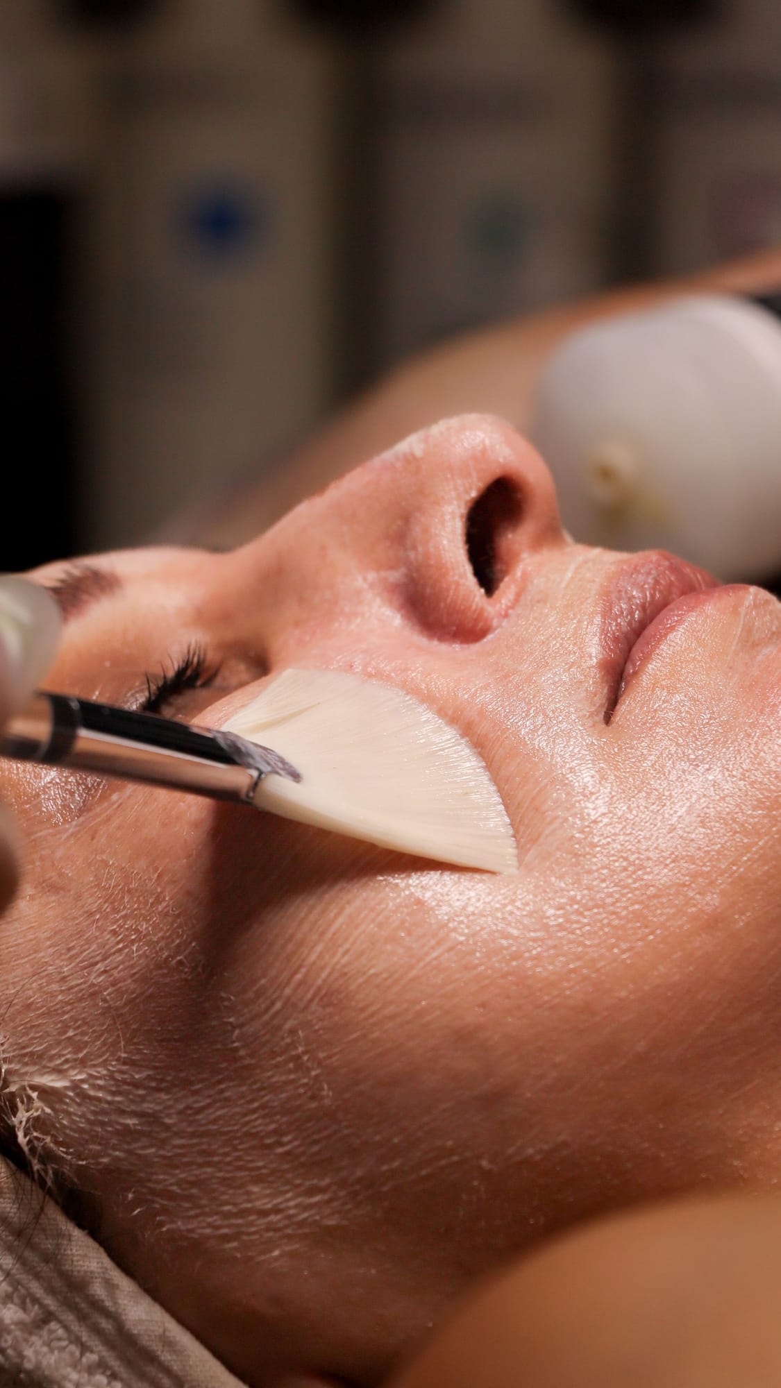 Peeling químico — Medical Linares