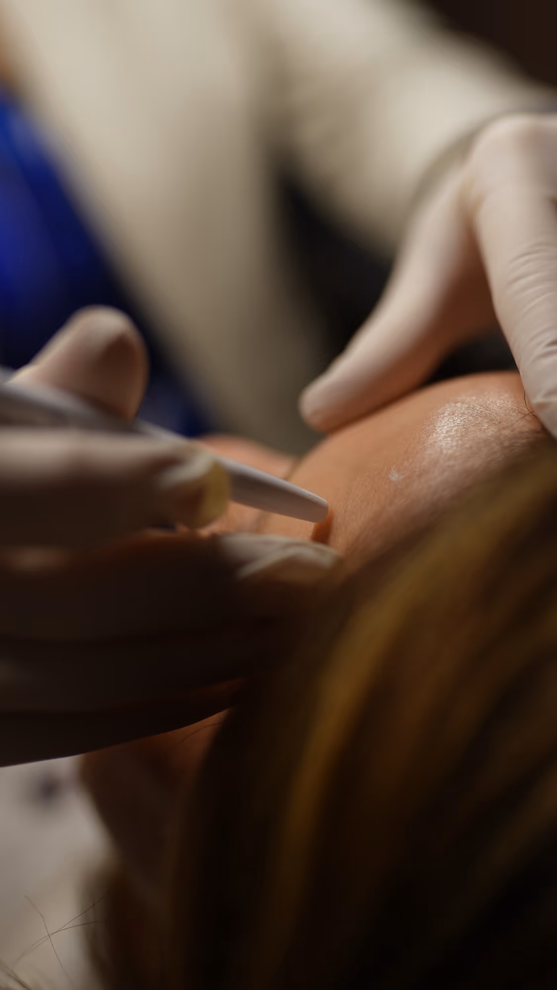 Retirada de Biopolímeros — Medical Linares