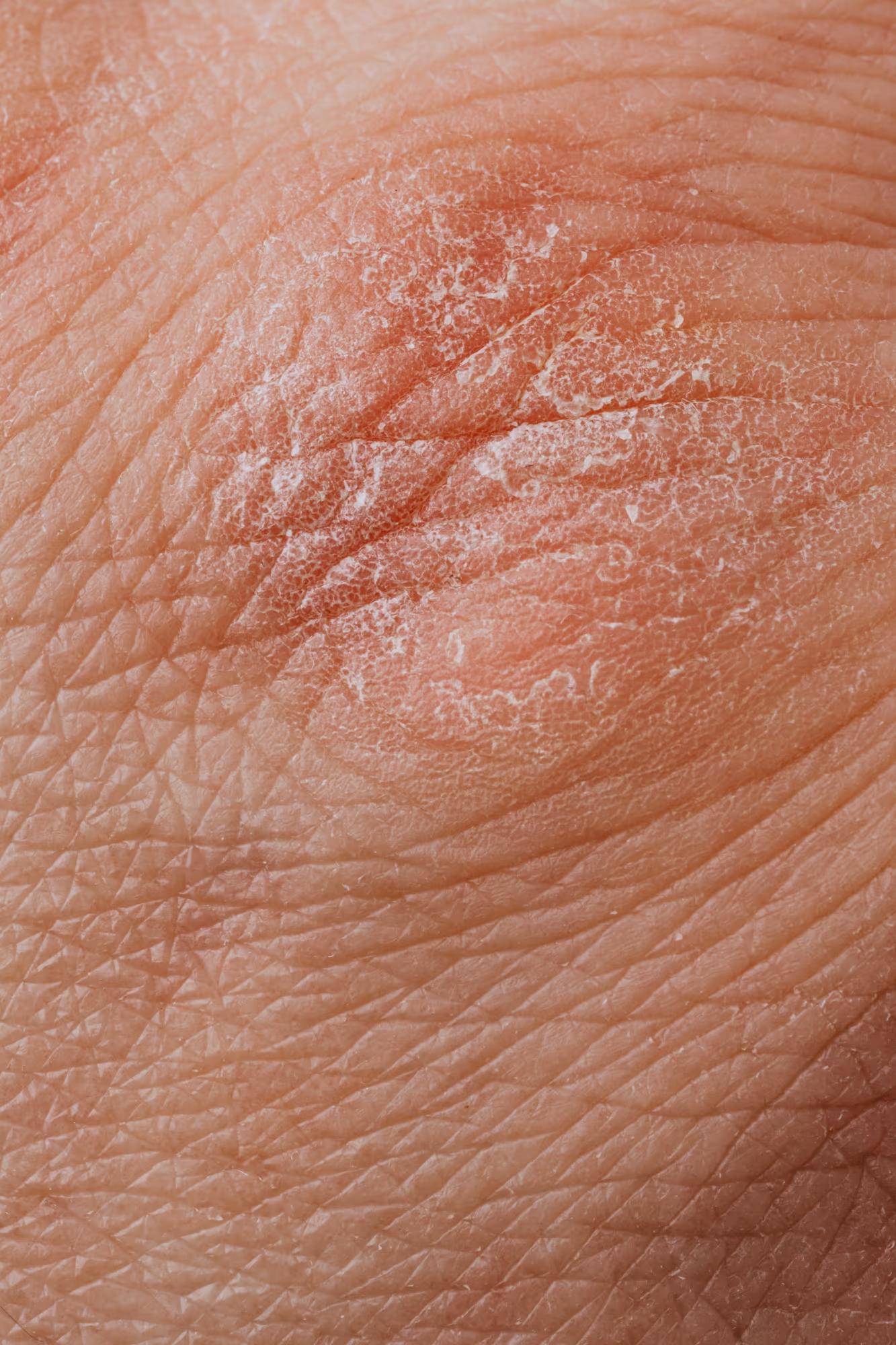 Psoriasis y Eccema — Medical Linares