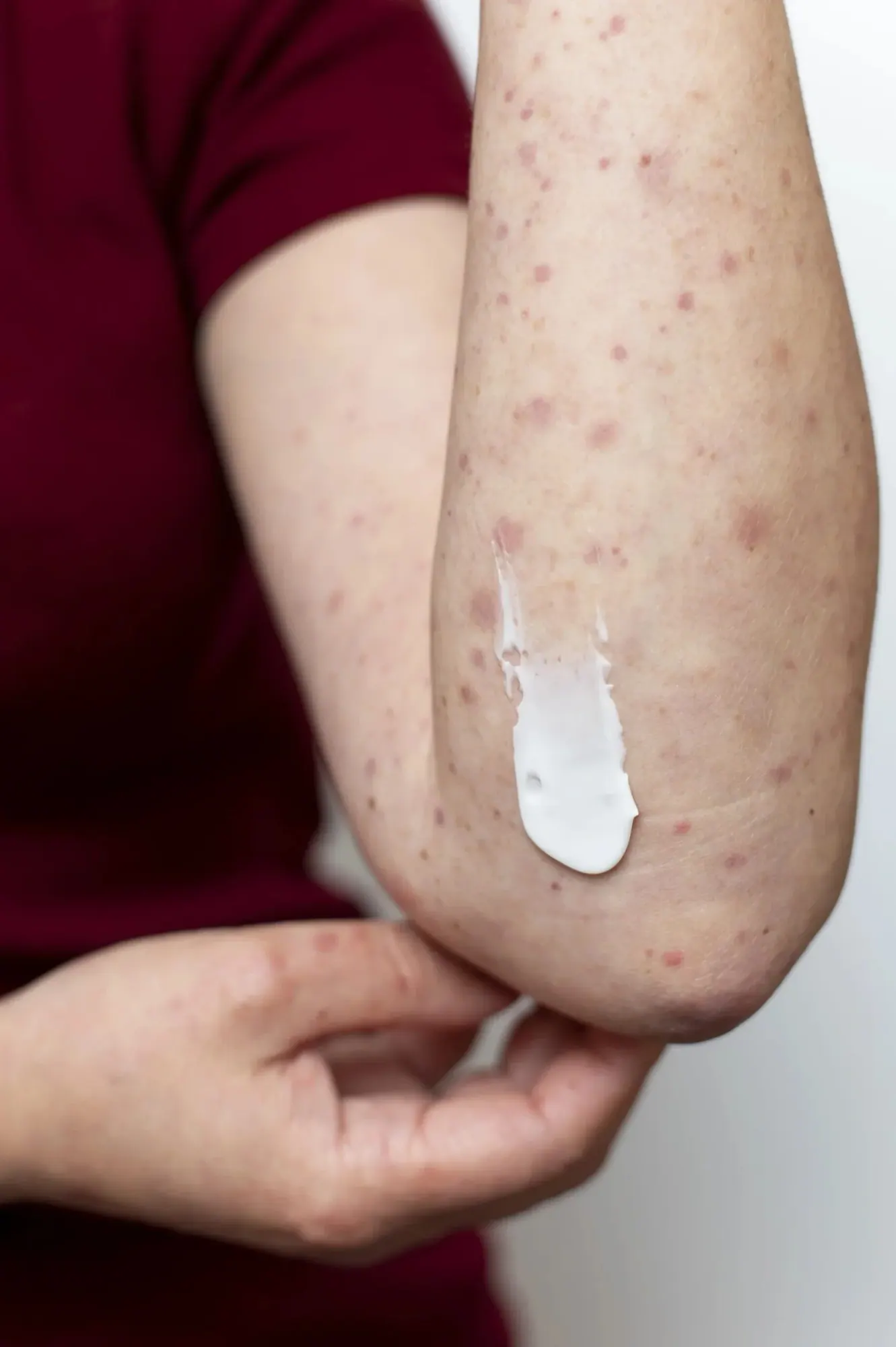 Dermatitis Seborreica — Medical Linares