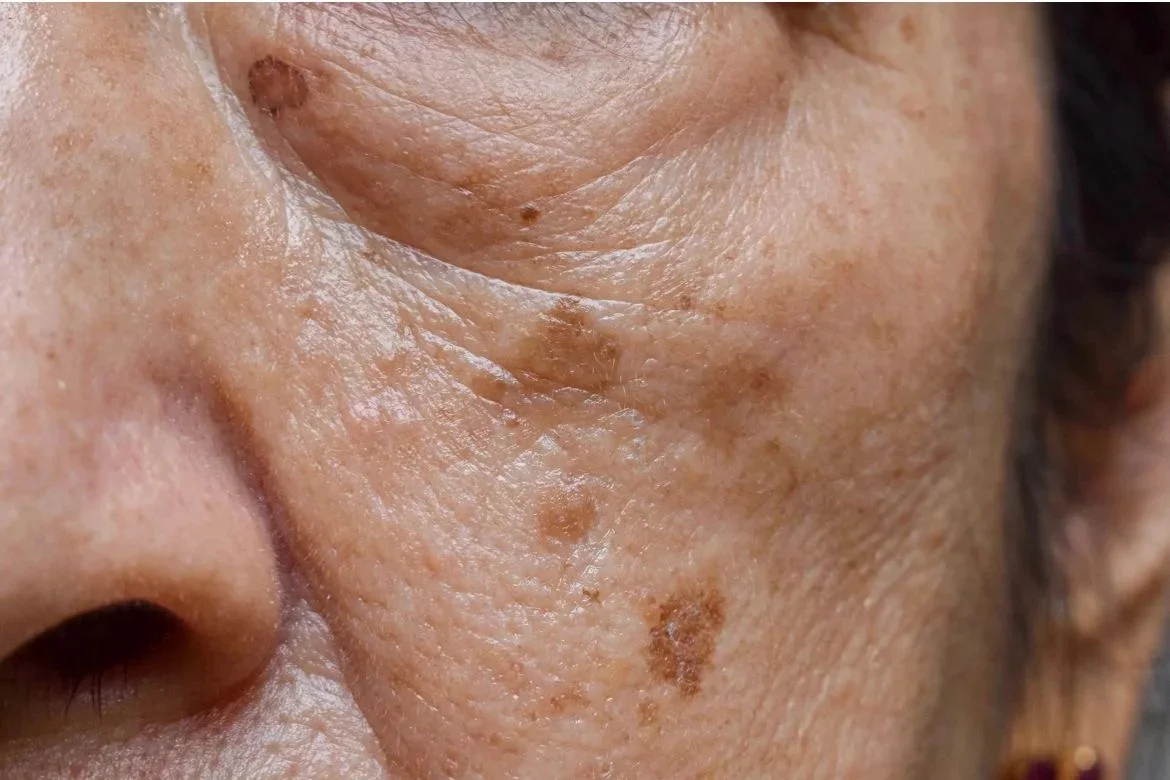 Manchas y melasma en Medical Linares