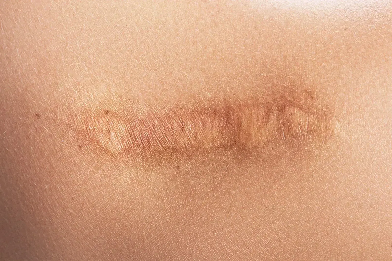 Cicatrices y estrías — Medical Linares