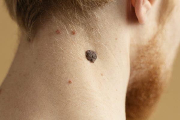 close-up-young-man-with-mole-neck-min-min