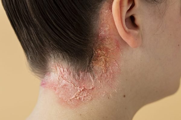 psoriasis-eczema-neck-patient-min-min