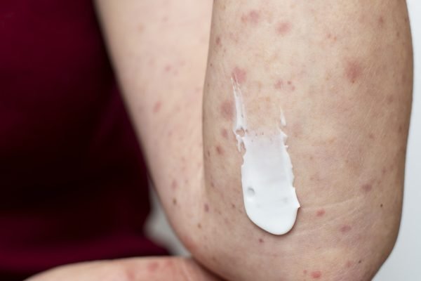 skin-allergy-person-s-arm-min-min